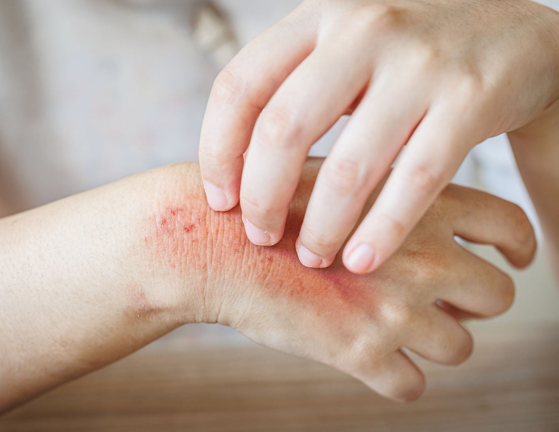 6 Things to Avoid When Your Skin Is Cracked, Irritated or Experiencing an Eczema Flare