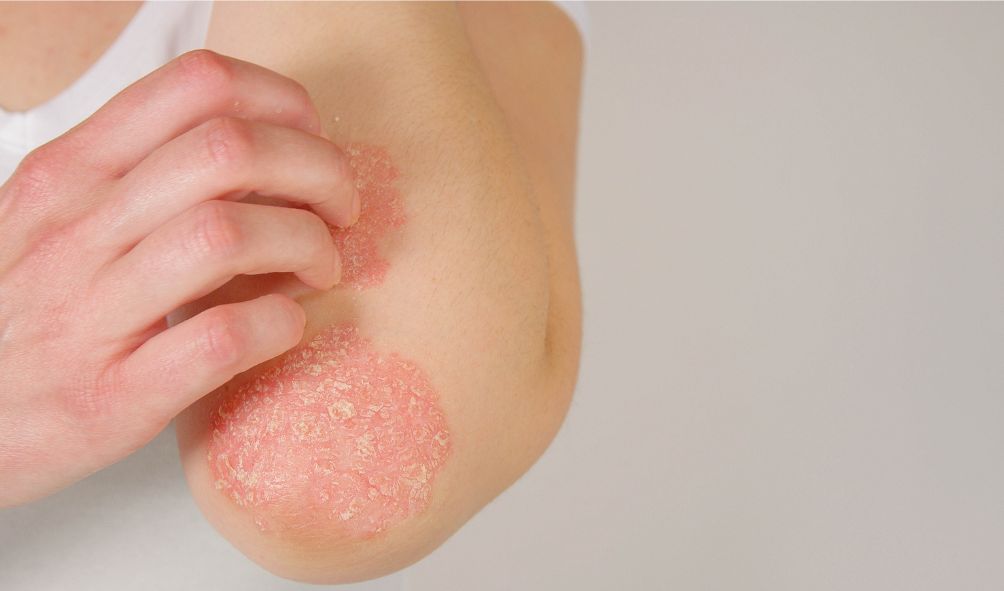 Why Does My Child Keep Scratching? Understanding Eczema Itch