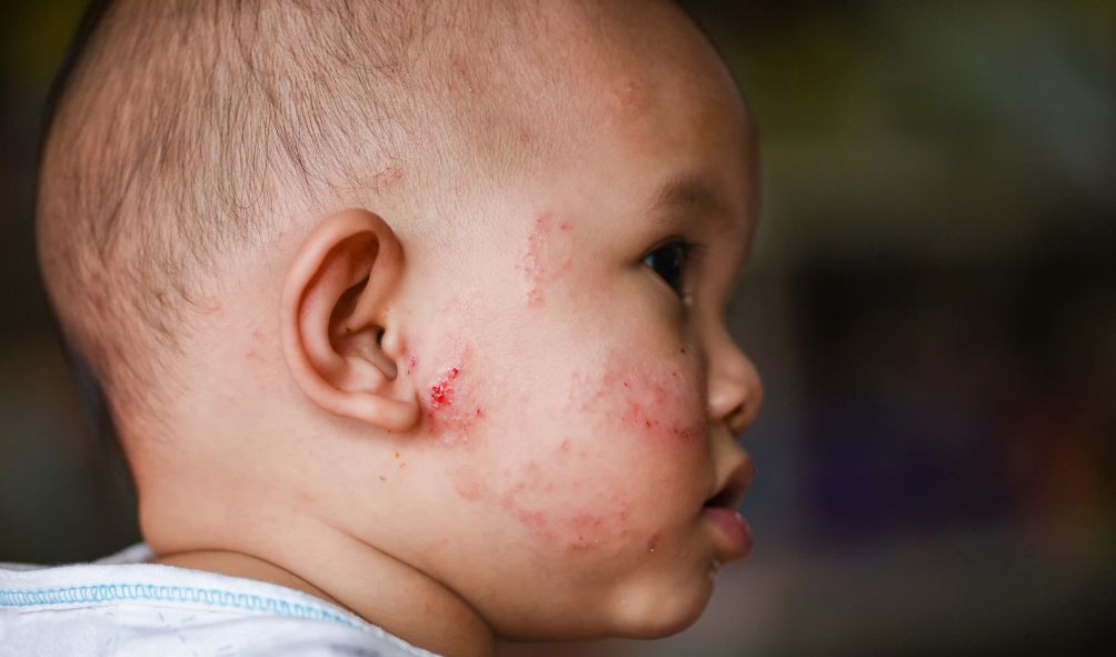 Dry Skin vs Eczema: How to Tell the Difference in Children